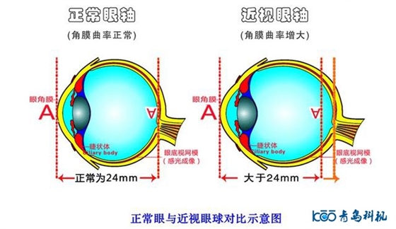 角膜塑形镜