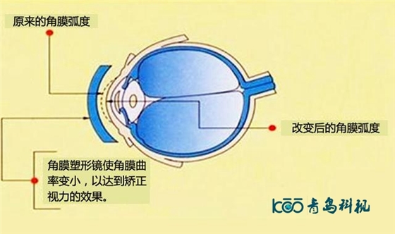 角膜塑形镜