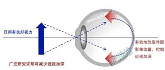角膜塑形镜
