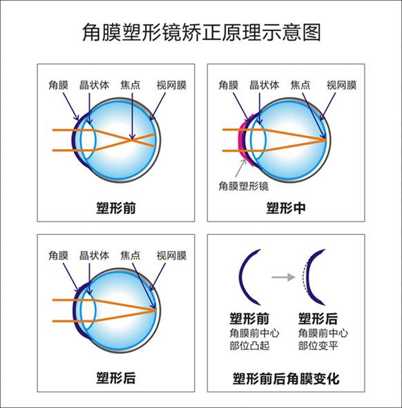 为什么科视角膜塑形镜能有效控制近视加深